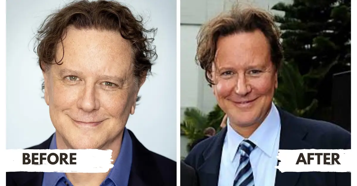 Judge Reinhold Plastic Surgery